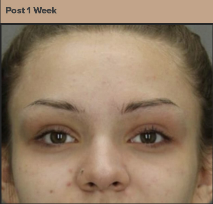 Before receiving acne laser treatment