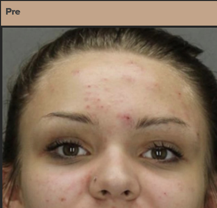 Before acne laser treatments