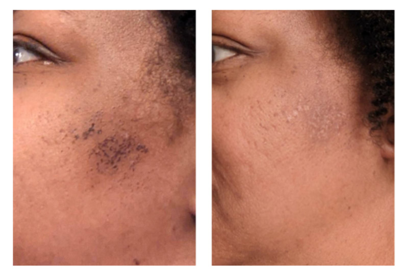 close up of before and after ADVATx treatments on patient who suffered with melasma