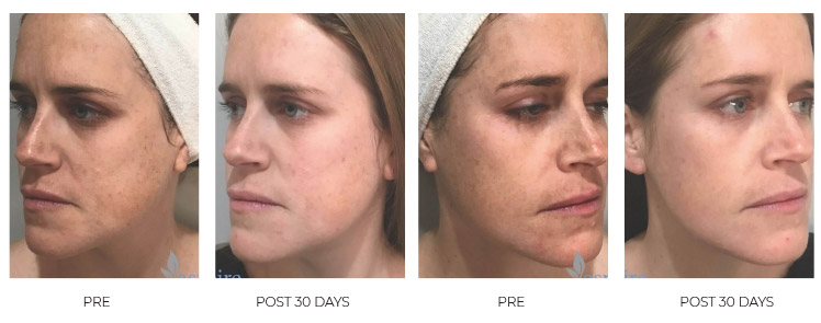 Successful ADVATx treatments on patient who suffered with melasma