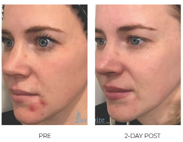 successful acne treatment before and after comparison