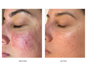 successful acne treatment on cheeks before and after comparison