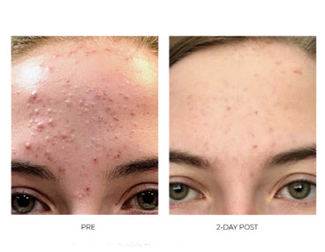 successful acne treatment on forehead before and after comparison