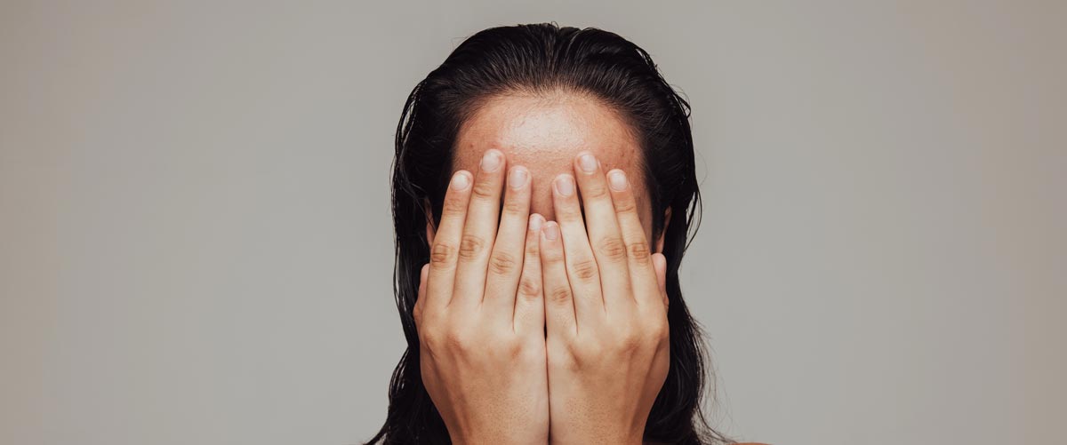 A young woman hiding her face because she has acne