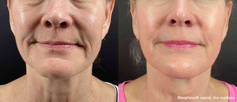 Before and after picture of the Morpheus8